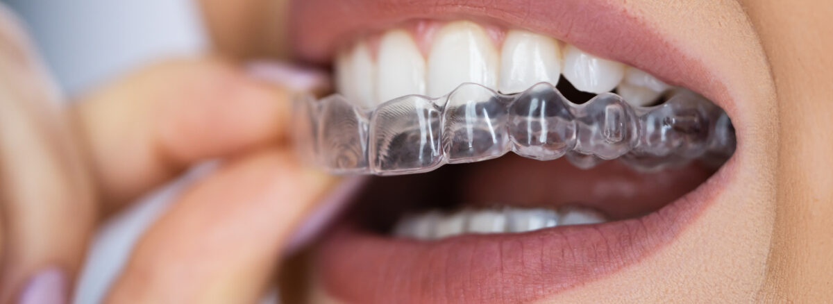 When Your Retainer Tightens: Navigating the Next Steps