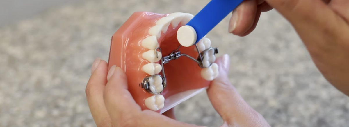 What is a Palatal Expander, and What is it Used For?