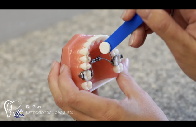 What is a Palatal Expander, and What is it Used For?